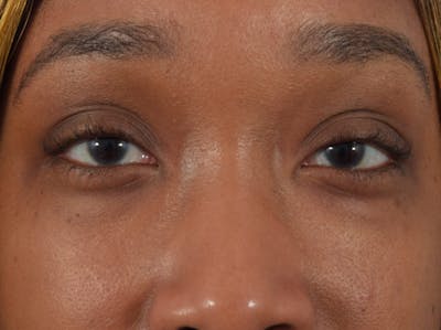 Filler-Tear Trough Before & After Gallery - Patient 36543217 - Image 2