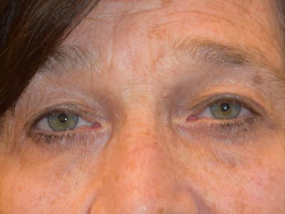 Filler-Tear Trough Before & After Gallery - Patient 36543218 - Image 2