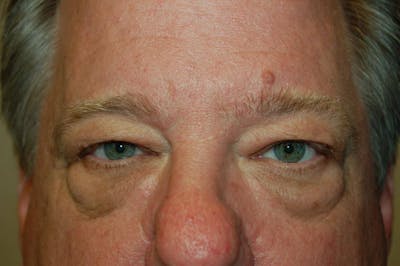 Mole Removal Before & After Gallery - Patient 36543228 - Image 1