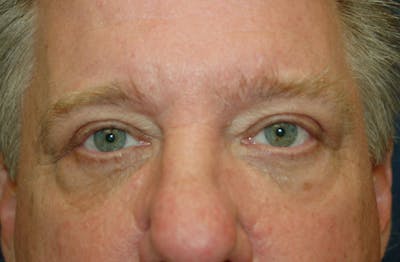 Mole Removal Before & After Gallery - Patient 36543228 - Image 2