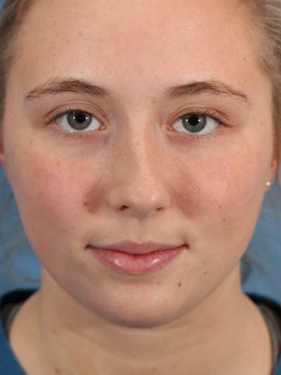 Rhinoplasty Before & After Gallery - Patient 36550401 - Image 1
