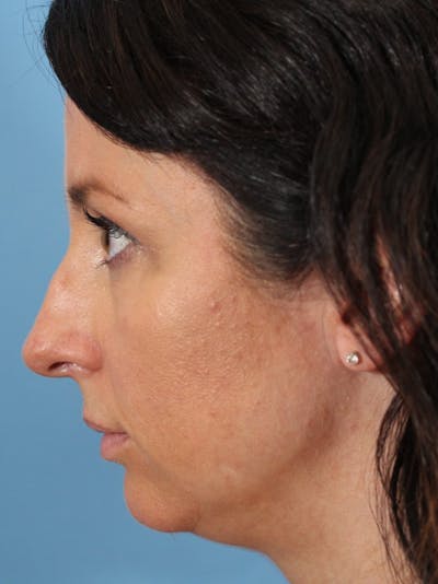 Rhinoplasty Before & After Gallery - Patient 36550402 - Image 1