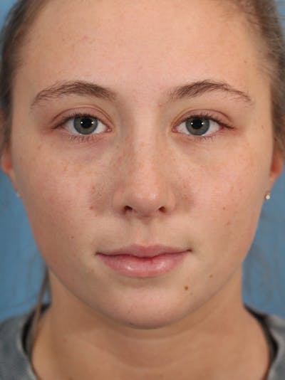 Rhinoplasty Before & After Gallery - Patient 36550401 - Image 2