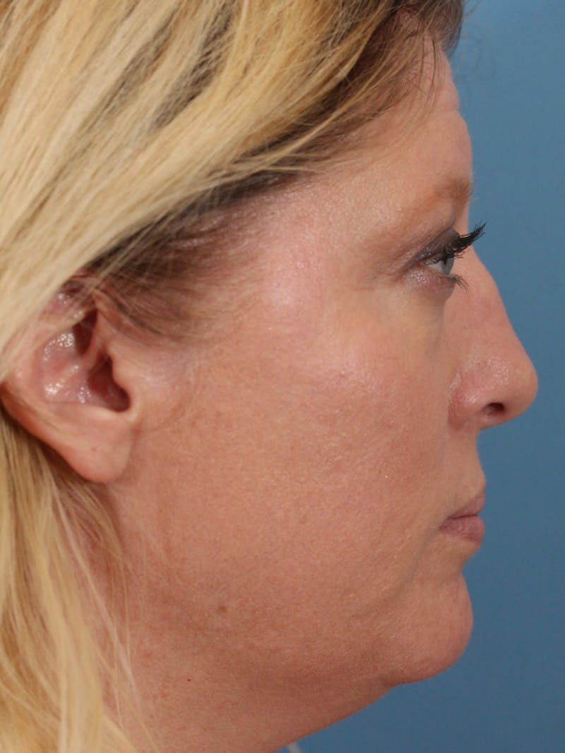 Rhinoplasty Before & After Gallery - Patient 36550405 - Image 1