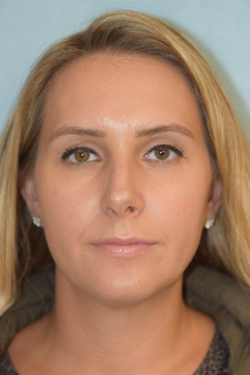 Rhinoplasty Before & After Gallery - Patient 36550406 - Image 1