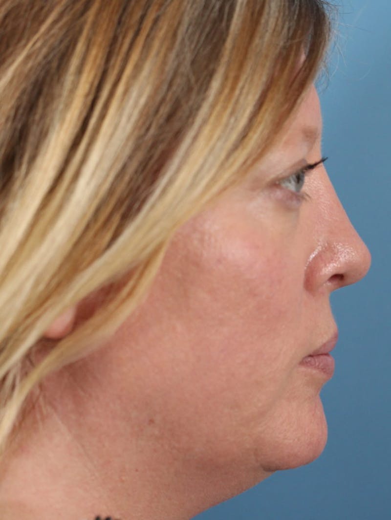 Rhinoplasty Before & After Gallery - Patient 36550405 - Image 2