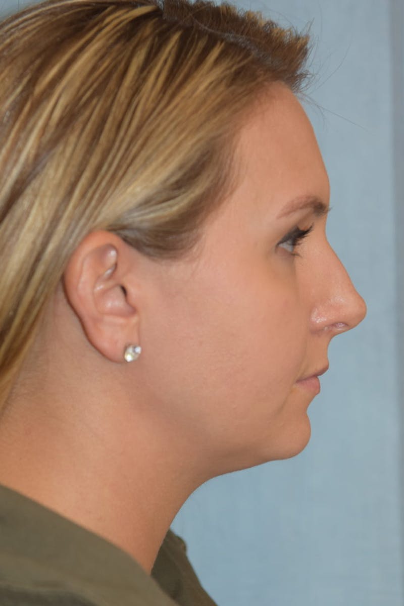 Rhinoplasty Before & After Gallery - Patient 36550406 - Image 3