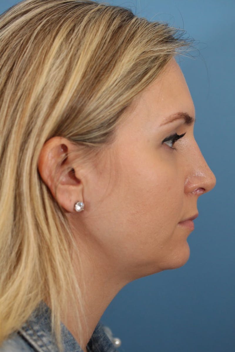 Rhinoplasty Before & After Gallery - Patient 36550406 - Image 4