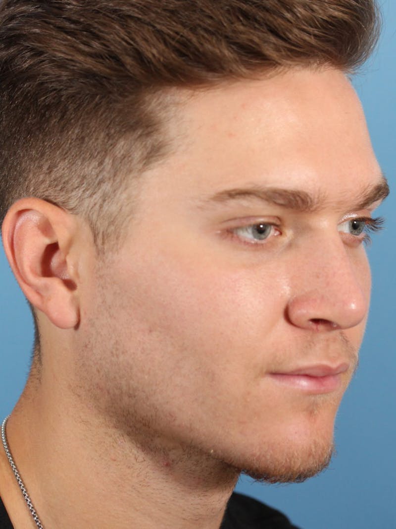 Rhinoplasty Before & After Gallery - Patient 36550407 - Image 4