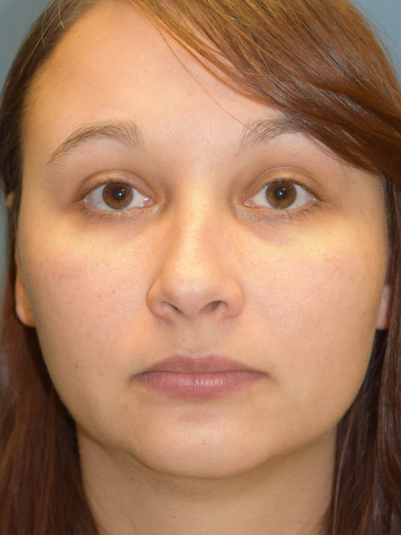 Rhinoplasty Before & After Gallery - Patient 36550408 - Image 1