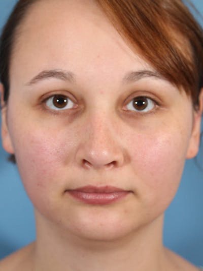 Rhinoplasty Before & After Gallery - Patient 36550408 - Image 2