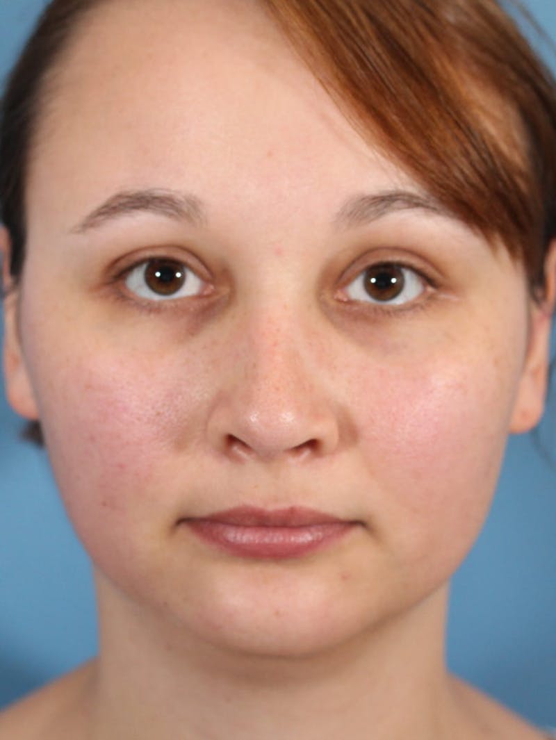 Rhinoplasty Before & After Gallery - Patient 36550408 - Image 2