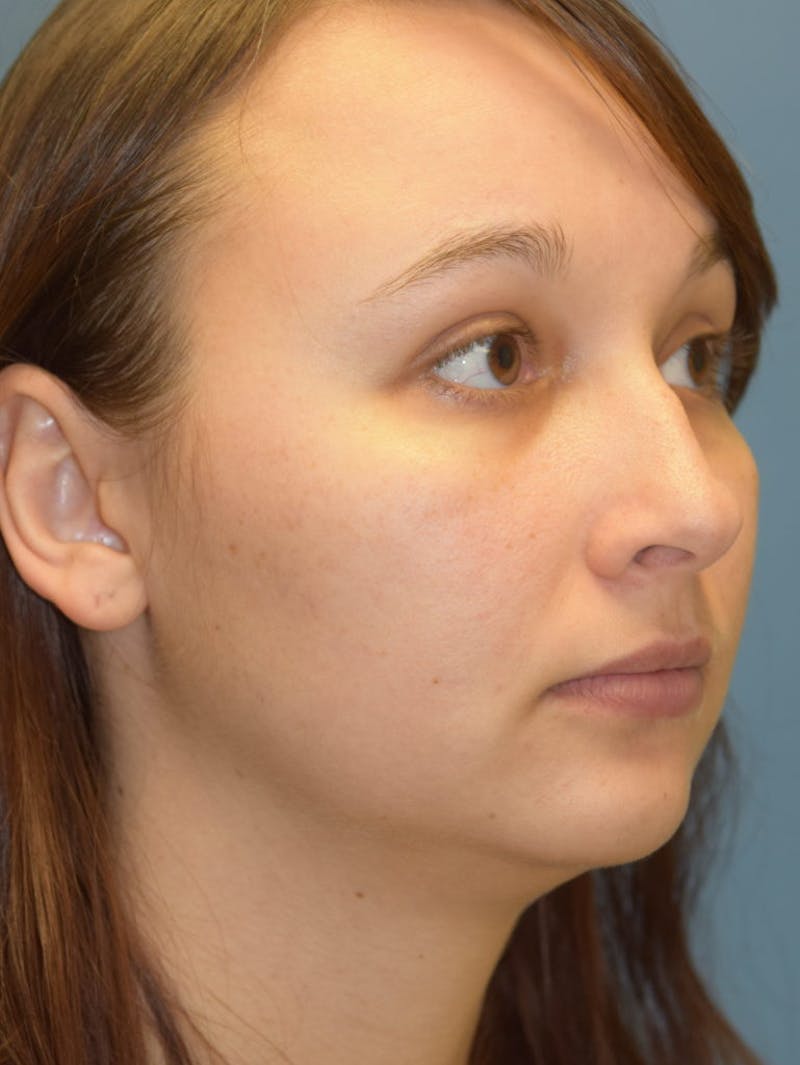Rhinoplasty Before & After Gallery - Patient 36550408 - Image 3