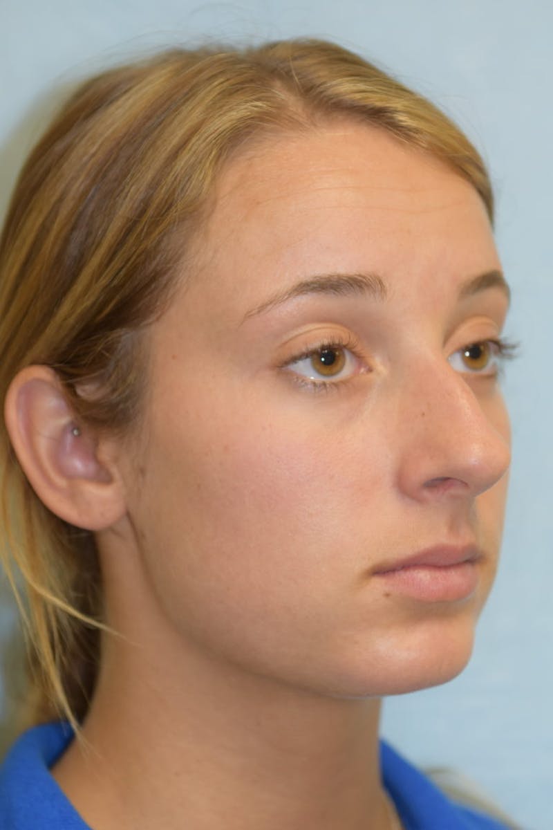 Rhinoplasty Before & After Gallery - Patient 36550410 - Image 3