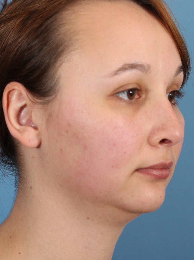 Rhinoplasty Before & After Gallery - Patient 36550408 - Image 4