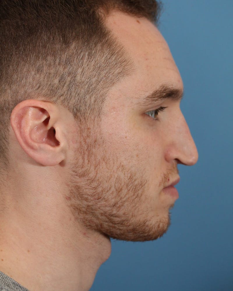 Rhinoplasty Before & After Gallery - Patient 36550409 - Image 5