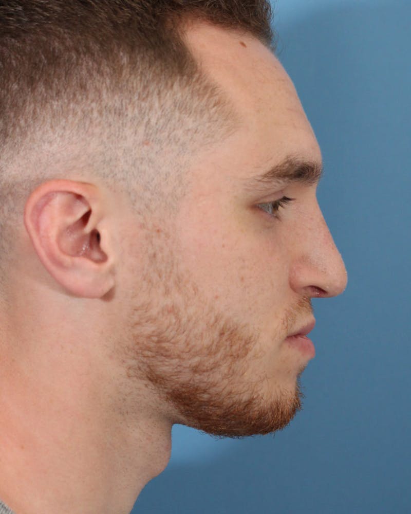 Rhinoplasty Before & After Gallery - Patient 36550409 - Image 6