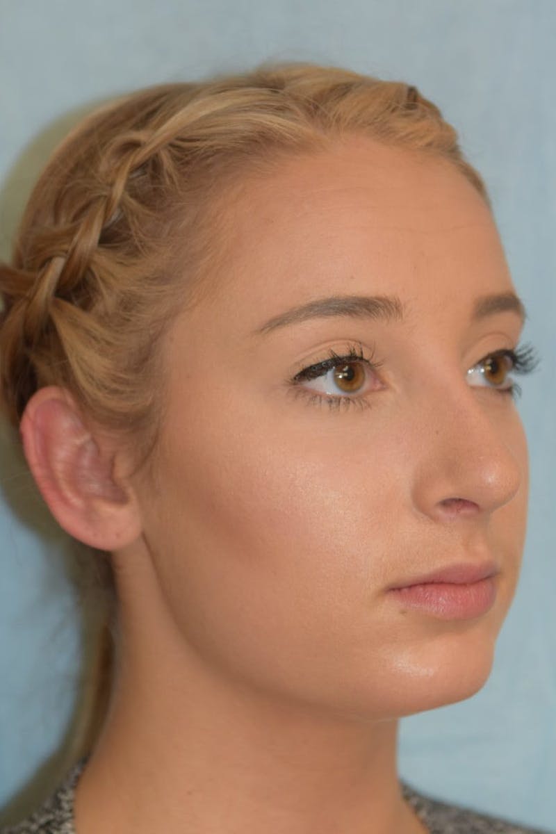 Rhinoplasty Before & After Gallery - Patient 36550410 - Image 4