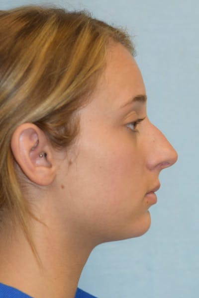 Rhinoplasty Before & After Gallery - Patient 36550410 - Image 1