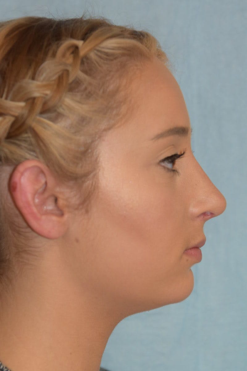 Rhinoplasty Before & After Gallery - Patient 36550410 - Image 4