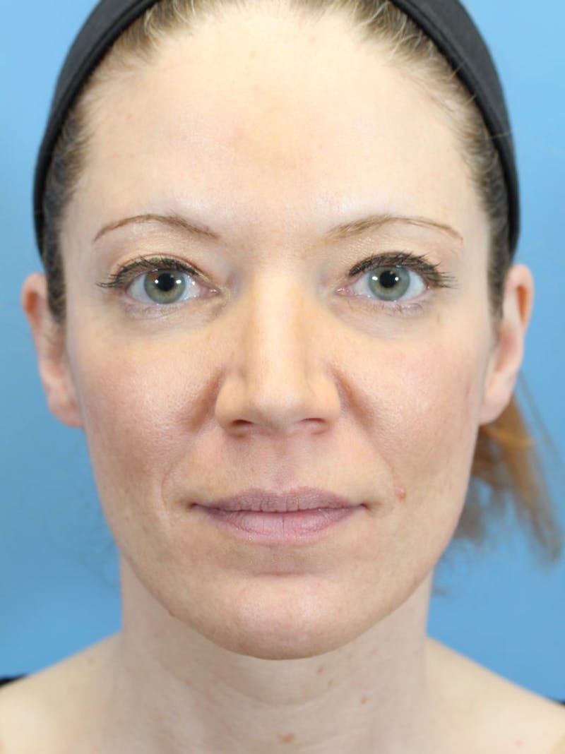 Rhinoplasty Before & After Gallery - Patient 36550411 - Image 1