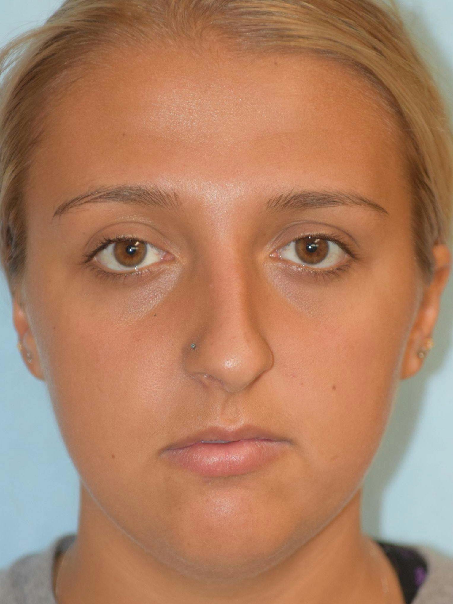 Rhinoplasty Before & After Photos Frankel Facial Plastic Surgery