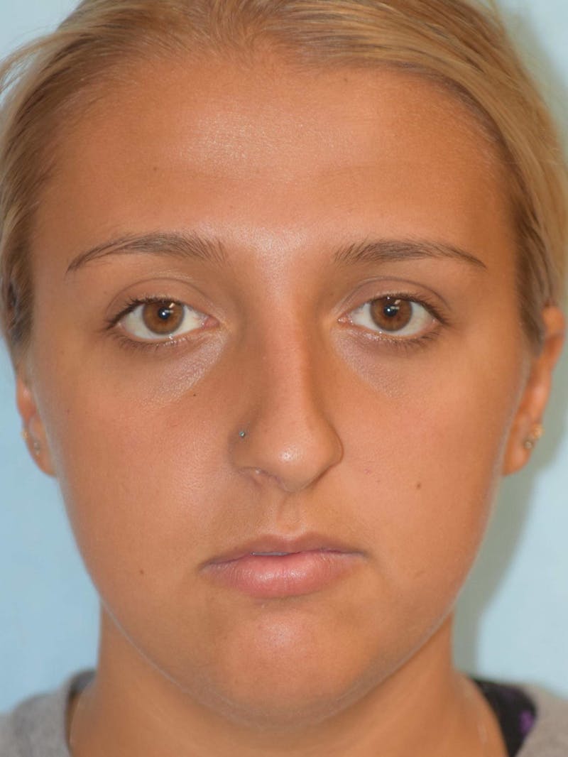 Rhinoplasty Before & After Gallery - Patient 36550413 - Image 1