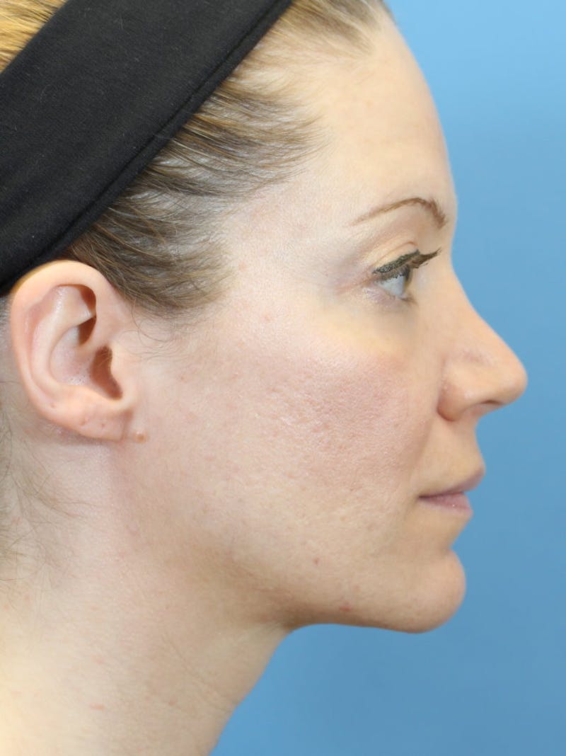 Rhinoplasty Before & After Gallery - Patient 36550411 - Image 3