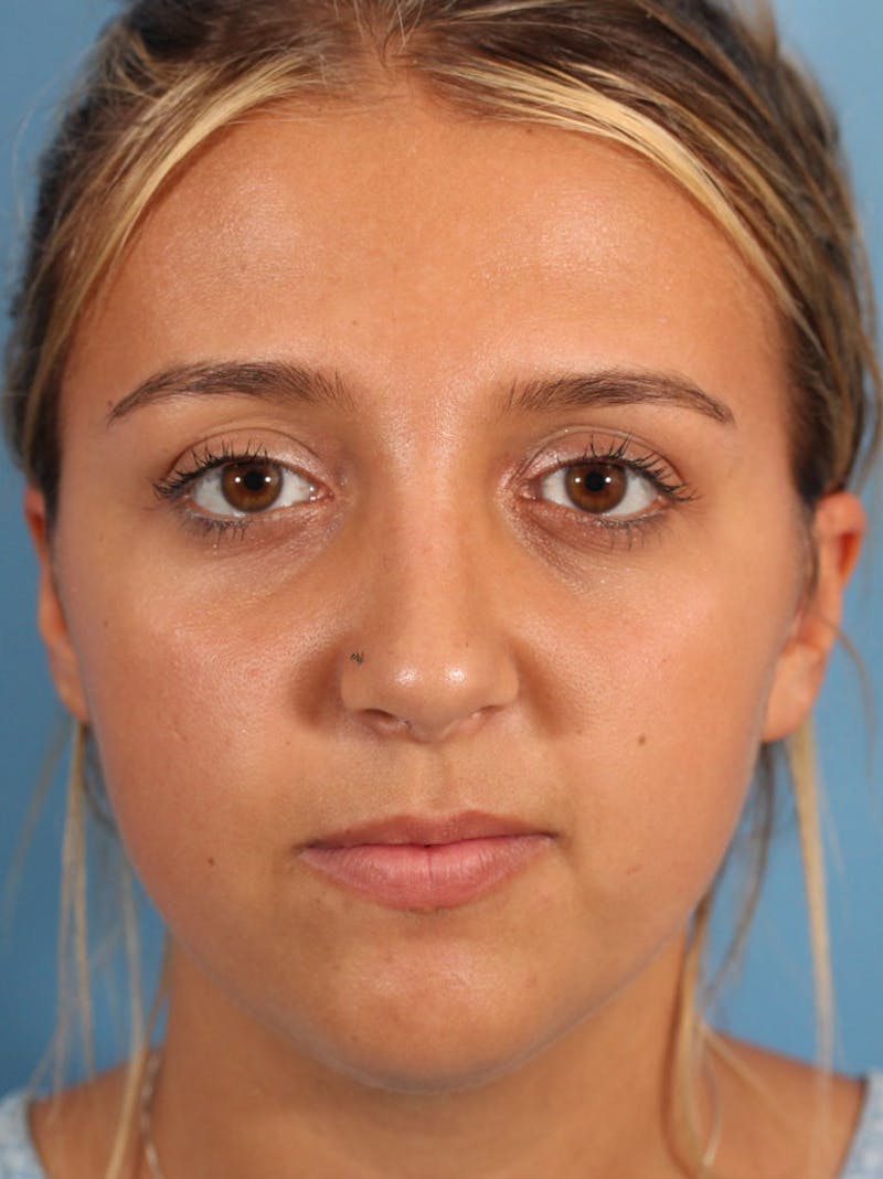 Rhinoplasty Before & After Gallery - Patient 36550413 - Image 2