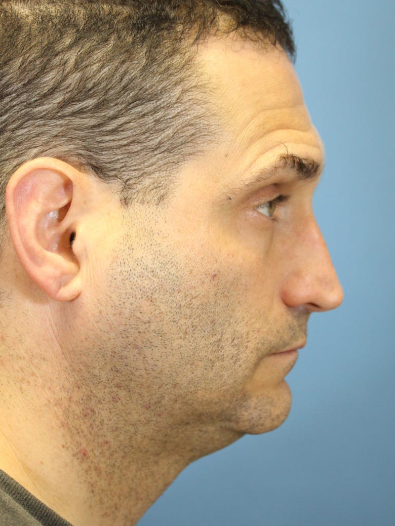 Rhinoplasty Before & After Gallery - Patient 36550412 - Image 3