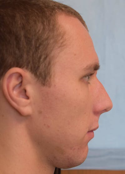 Rhinoplasty Before & After Gallery - Patient 36550414 - Image 1