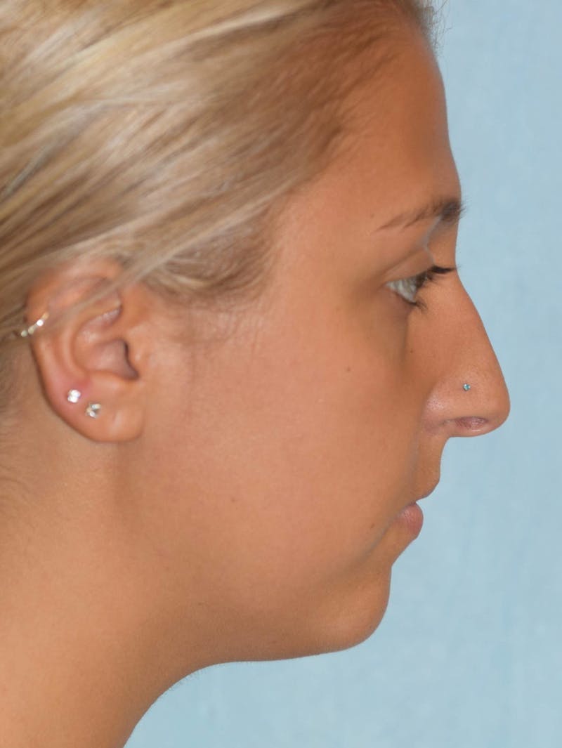 Rhinoplasty Before & After Gallery - Patient 36550413 - Image 5