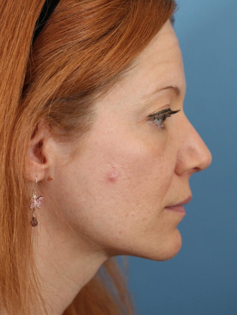 Rhinoplasty Before & After Gallery - Patient 36550411 - Image 4