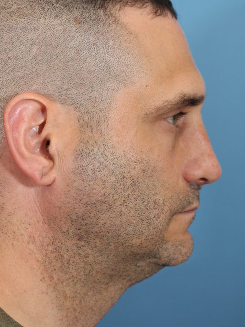 Rhinoplasty Before & After Gallery - Patient 36550412 - Image 4