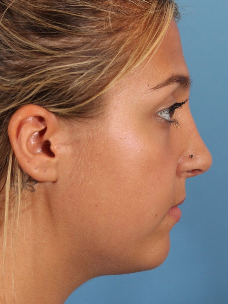 Rhinoplasty Before & After Gallery - Patient 36550413 - Image 6