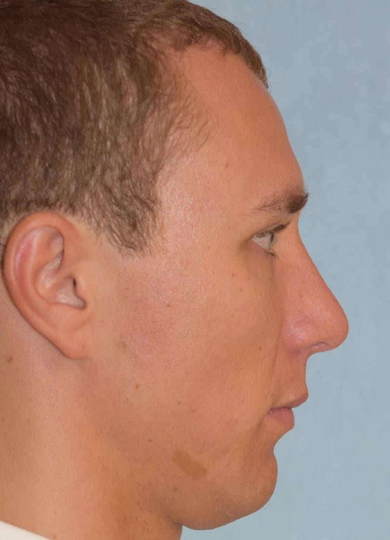 Rhinoplasty Before & After Gallery - Patient 36550414 - Image 2