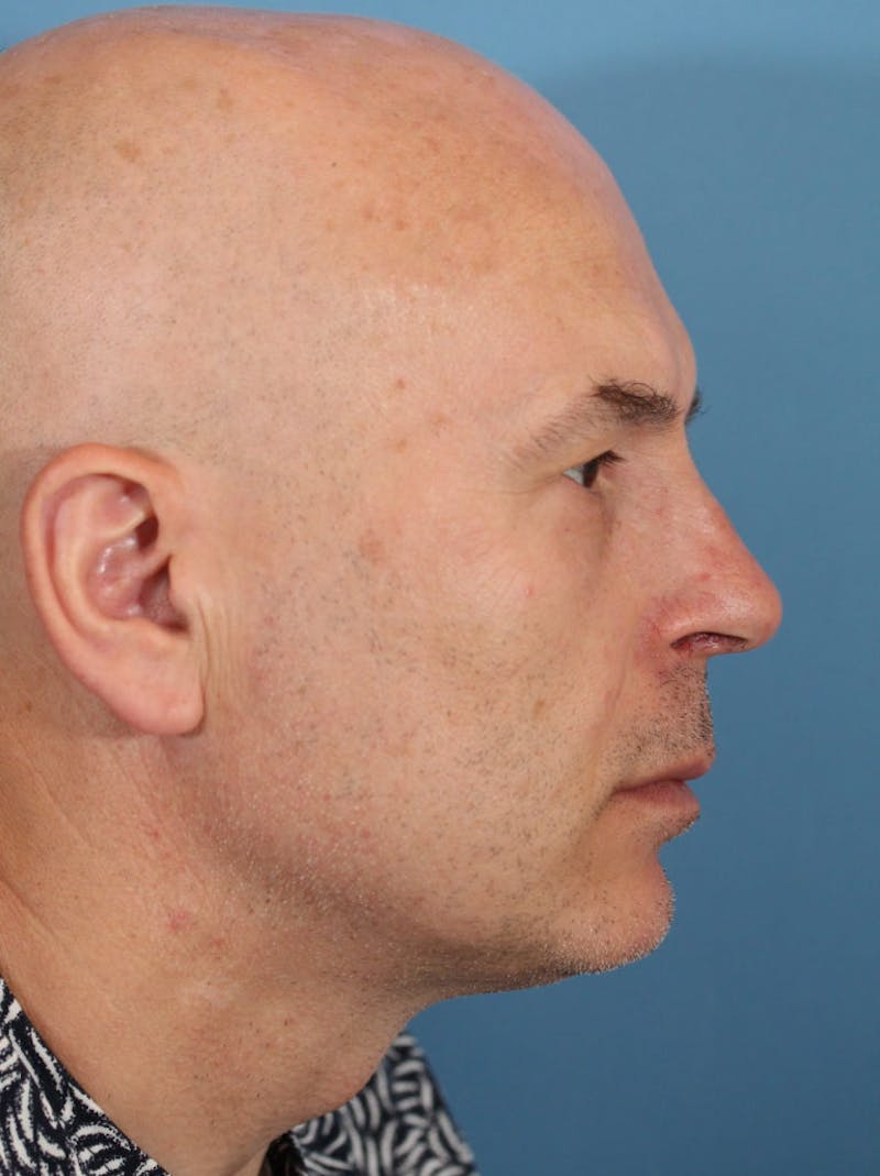 Rhinoplasty Before & After Gallery - Patient 36550415 - Image 4