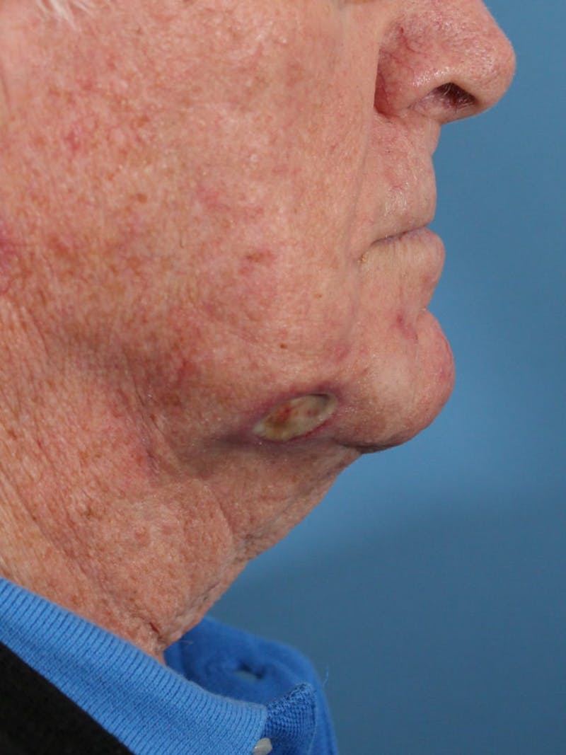 Skin Reconstruction Before & After Gallery - Patient 36550466 - Image 3