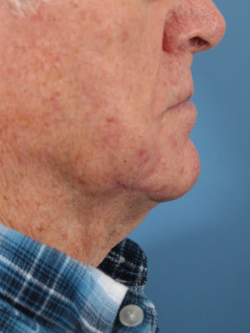Skin Reconstruction Before & After Gallery - Patient 36550466 - Image 4