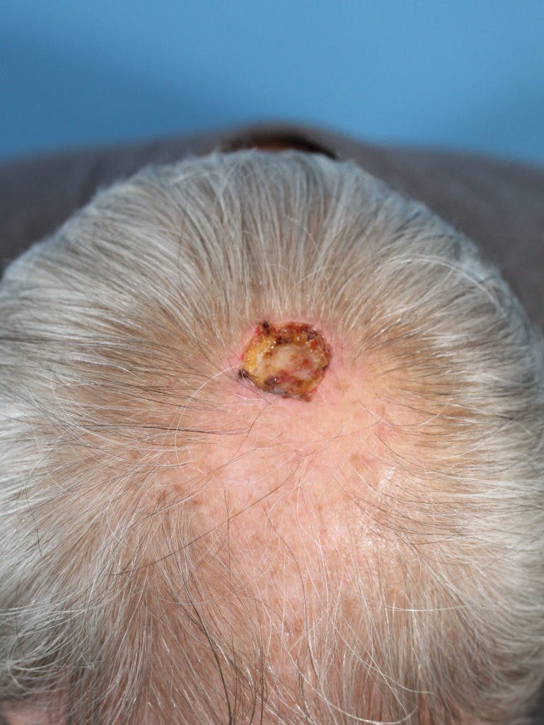 Skin Reconstruction Gallery - Patient 36550467 - Image 1