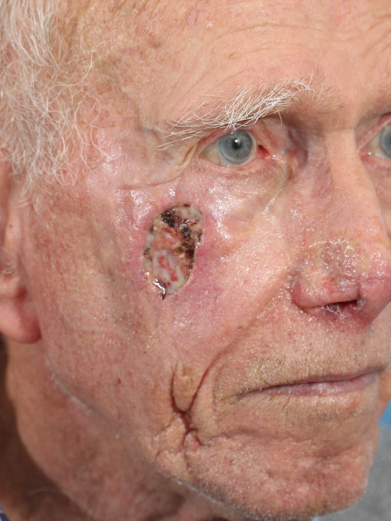 Skin Reconstruction Before & After Gallery - Patient 36550468 - Image 1