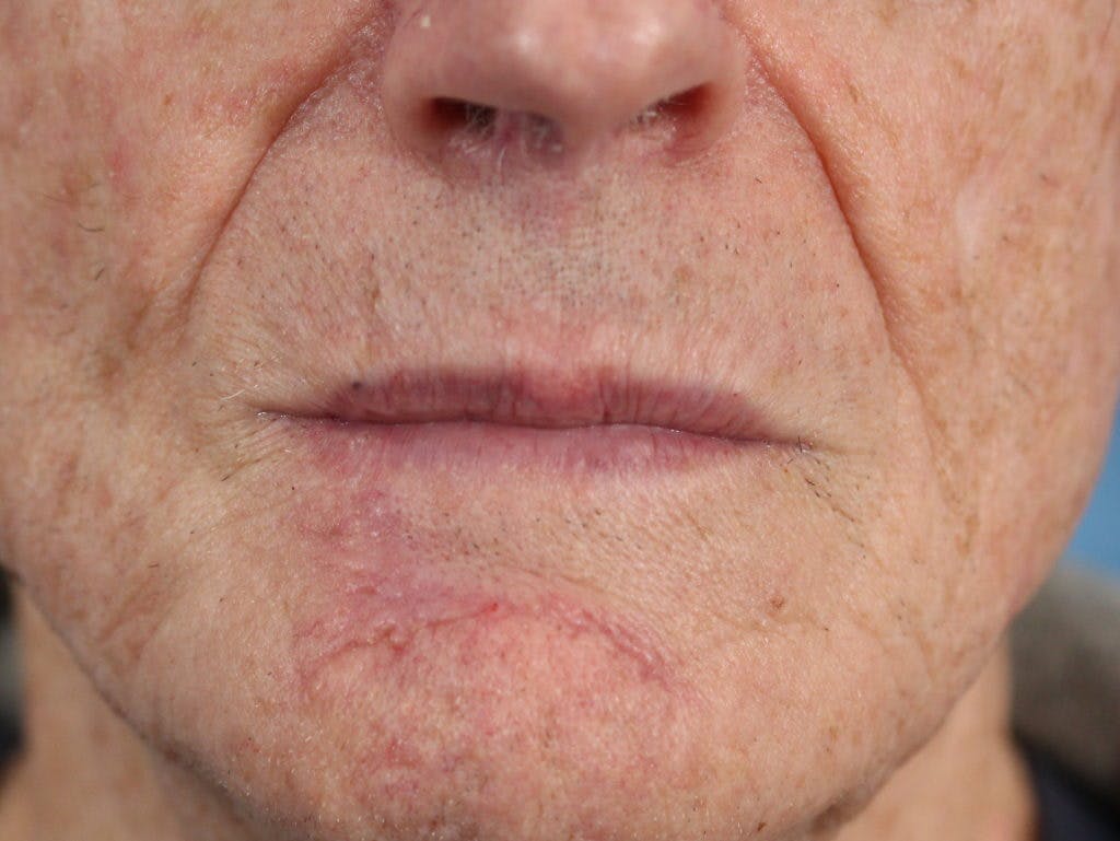 Skin Reconstruction Gallery - Patient 36550469 - Image 2