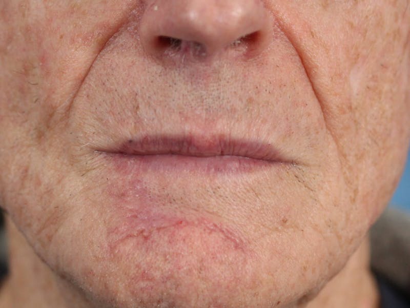 Skin Reconstruction Before & After Gallery - Patient 36550469 - Image 2
