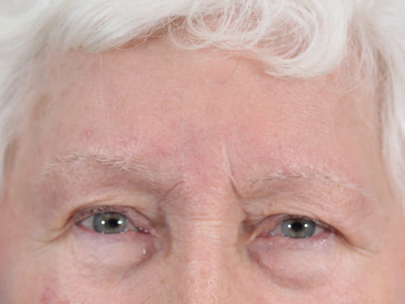 Skin Reconstruction Before & After Gallery - Patient 36550470 - Image 2