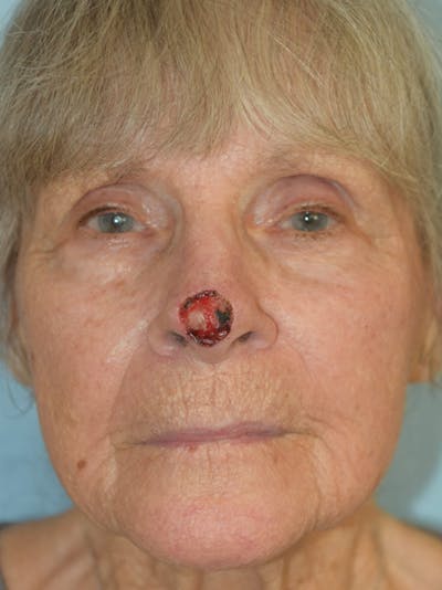 Skin Reconstruction Before & After Gallery - Patient 36550472 - Image 1