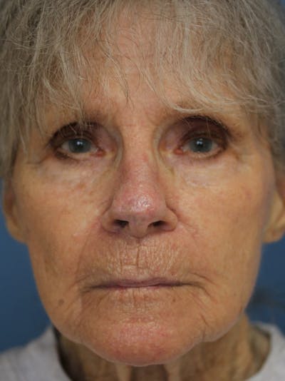 Skin Reconstruction Before & After Gallery - Patient 36550472 - Image 2