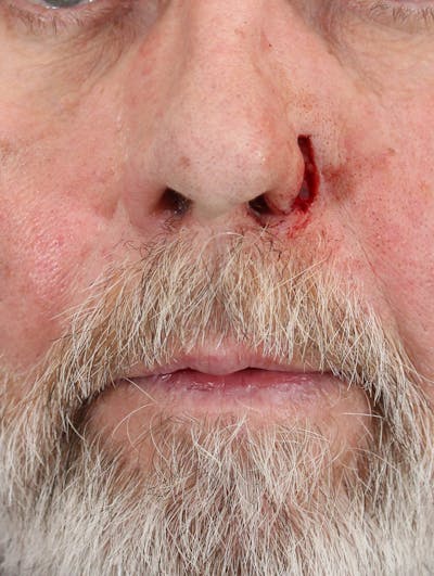 Skin Reconstruction Before & After Gallery - Patient 36550473 - Image 1