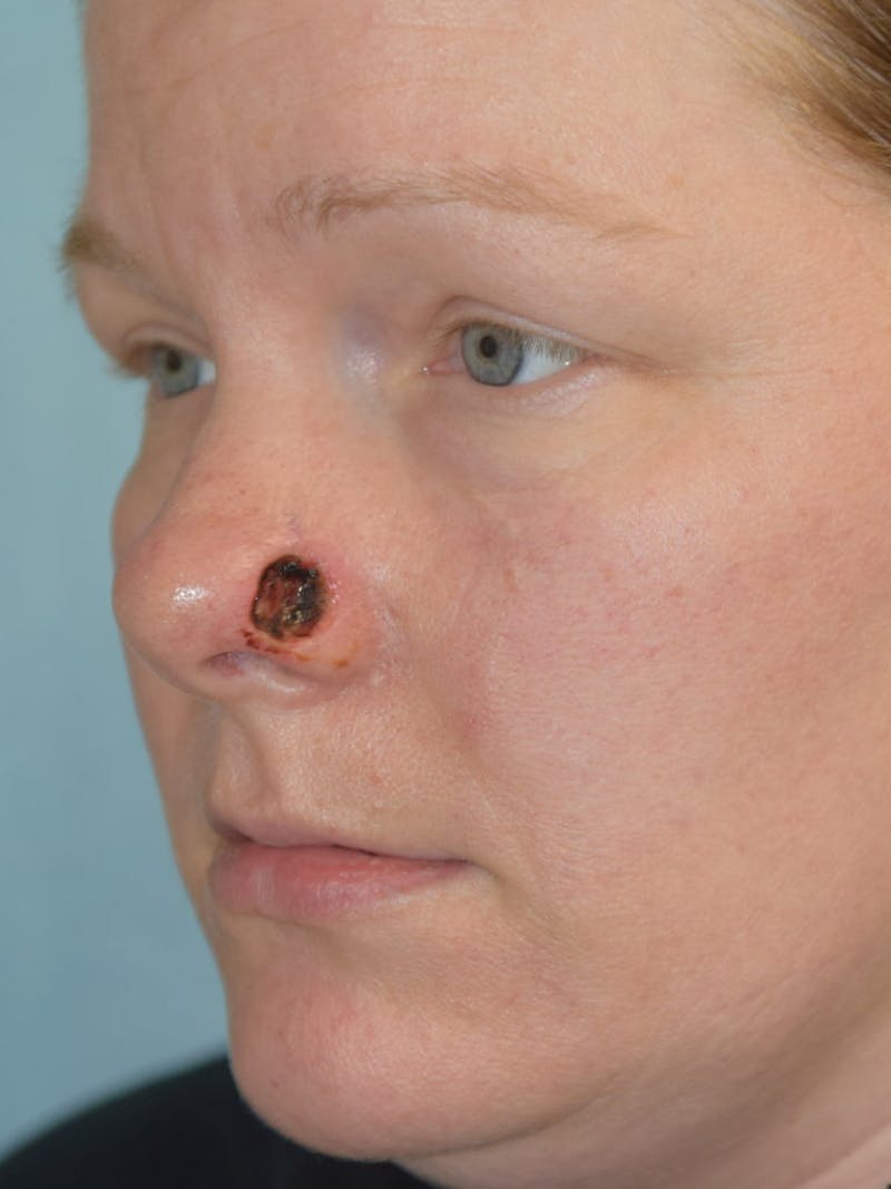 Skin Reconstruction Before & After Gallery - Patient 36550474 - Image 1