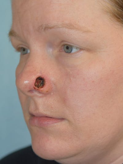 Skin Reconstruction Before & After Gallery - Patient 36550474 - Image 1
