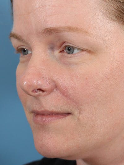 Skin Reconstruction Before & After Gallery - Patient 36550474 - Image 2